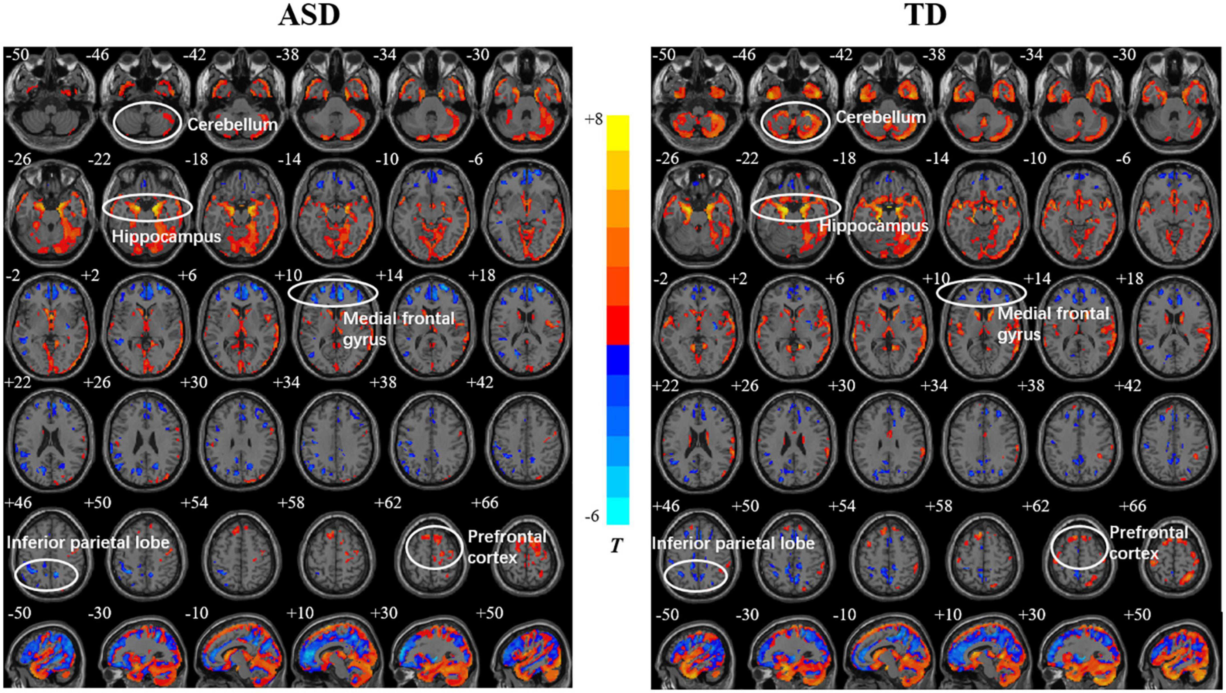 Relationship between gray matter structure and age in children and adolescents with high-functioning autism spectrum disorder
